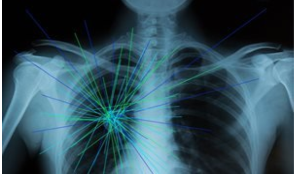xray of lungs with lights pinpointing a tumor