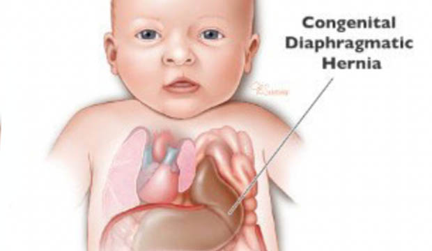 graphic of diaphragmatic hernia in infant